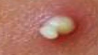 Marie's Enormous Cysts!  Pimple Popping, Cysts & Abscesses!  Carbuncles & Furuncles