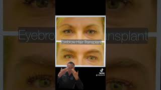 Eyebrow Transplant Principles (Short Version)