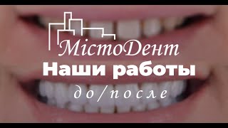 Сучасна Стоматологія у Львові - Лікування дорослих та дітей - МістоДент - Протезування зубів