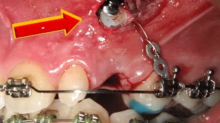 HOW #BRACES WORK Awful Bucally IMPACTED #CANINE, before and after #timelapse