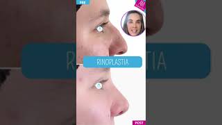 Rinoplastia ✨