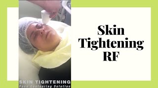 SKIN TIGHTENING RF | Painless Non-surgical facelift