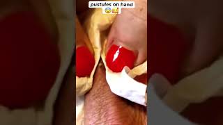 Pimple Popper on Finger #oddlysatisfying #sick #blackhead #pimplepopper #satisfying #cyst #wow #acne